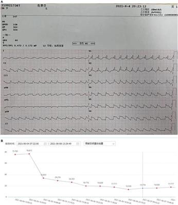 Case Report: Early Resection of Pheochromocytoma in a Patient With Cardiogenic Shock Due to Pheochromocytoma-Induced Cardiomyopathy With Extracorporeal Life Support